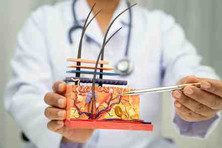 Arzt zeigt mit Kugelschreiber auf Modell von Haarwurzel